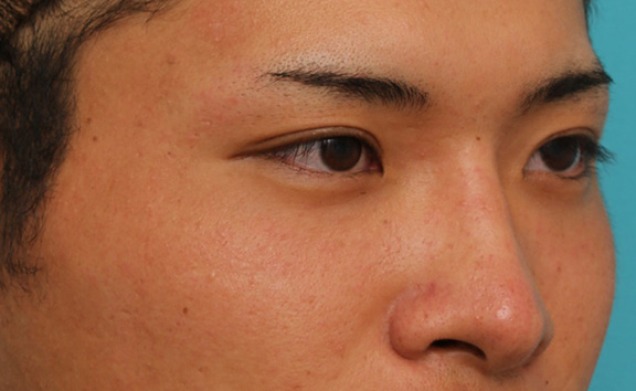 隆鼻注射（ヒアルロン酸注射）,長期持続型ヒアルロン酸により鼻を高くした症例写真,After（1ヶ月後）,ba_ryubi2031_b03.jpg