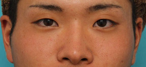 隆鼻注射（ヒアルロン酸注射）,長期持続型ヒアルロン酸により鼻を高くした症例写真,Before,ba_ryubi2031_b01.jpg
