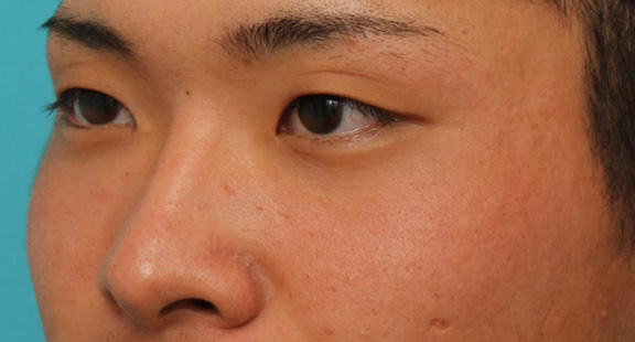 隆鼻注射（ヒアルロン酸注射）,長期持続型ヒアルロン酸により鼻を高くした症例写真,Before,ba_ryubi2031_b02.jpg