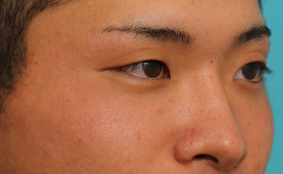 隆鼻注射（ヒアルロン酸注射）,長期持続型ヒアルロン酸により鼻を高くした症例写真,Before,ba_ryubi2031_b03.jpg