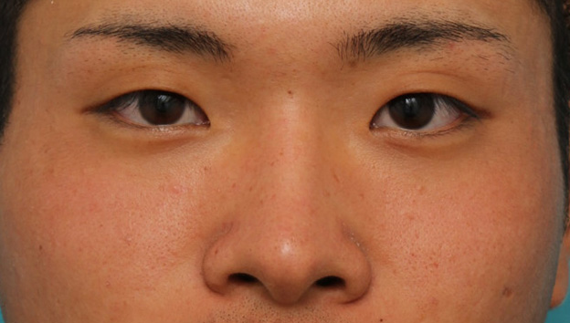 隆鼻注射（ヒアルロン酸注射）,長期持続型ヒアルロン酸により鼻を高くした症例写真,手術前,mainpic_ryubi2031a.jpg