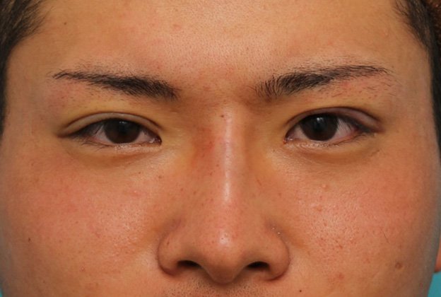 隆鼻注射（ヒアルロン酸注射）,長期持続型ヒアルロン酸により鼻を高くした症例写真,手術直後,mainpic_ryubi2031b.jpg