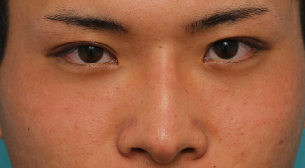 隆鼻注射（ヒアルロン酸注射）,長期持続型ヒアルロン酸により鼻を高くした症例写真,1週間後,mainpic_ryubi2031c.jpg
