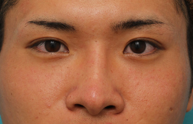 隆鼻注射（ヒアルロン酸注射）,長期持続型ヒアルロン酸により鼻を高くした症例写真,1ヶ月後,mainpic_ryubi2031d.jpg