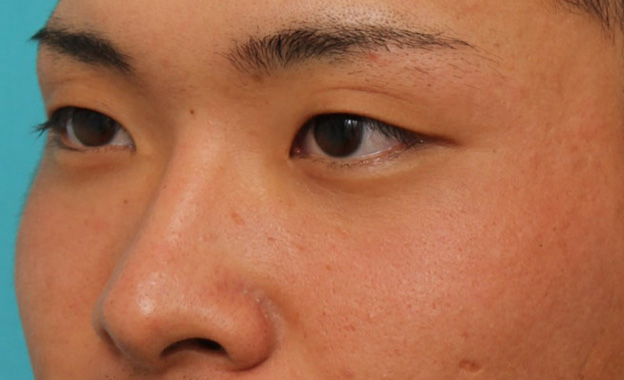 隆鼻注射（ヒアルロン酸注射）,長期持続型ヒアルロン酸により鼻を高くした症例写真,手術前,mainpic_ryubi2031e.jpg
