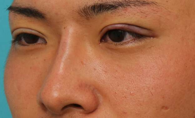 隆鼻注射（ヒアルロン酸注射）,長期持続型ヒアルロン酸により鼻を高くした症例写真,手術直後,mainpic_ryubi2031f.jpg