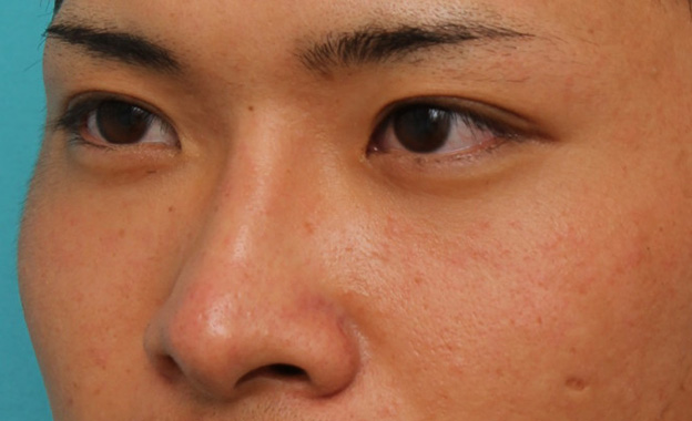 隆鼻注射（ヒアルロン酸注射）,長期持続型ヒアルロン酸により鼻を高くした症例写真,1ヶ月後,mainpic_ryubi2031h.jpg