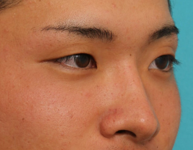 隆鼻注射（ヒアルロン酸注射）,長期持続型ヒアルロン酸により鼻を高くした症例写真,手術前,mainpic_ryubi2031i.jpg