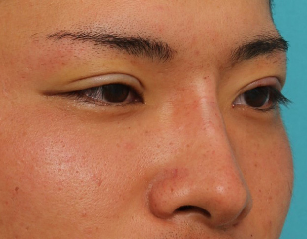 隆鼻注射（ヒアルロン酸注射）,長期持続型ヒアルロン酸により鼻を高くした症例写真,手術直後,mainpic_ryubi2031j.jpg