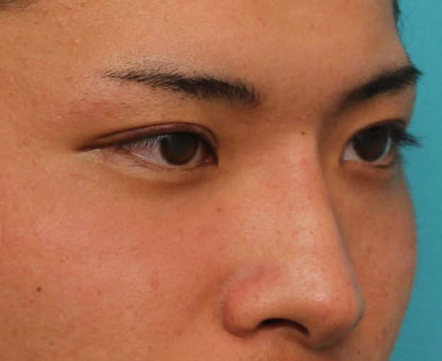 隆鼻注射（ヒアルロン酸注射）,長期持続型ヒアルロン酸により鼻を高くした症例写真,1週間後,mainpic_ryubi2031k.jpg