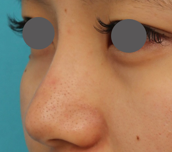 隆鼻術（シリコンプロテーゼ）,鼻シリコンプロテーゼ+鼻先の耳介軟骨移植を行い自然な形で鼻筋を通した症例写真,After（6ヶ月後）,ba_ryubi1048_b02.jpg