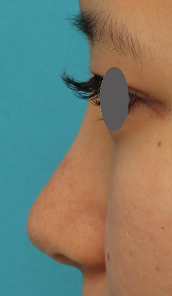 隆鼻術（シリコンプロテーゼ）,鼻シリコンプロテーゼ+鼻先の耳介軟骨移植を行い自然な形で鼻筋を通した症例写真,After（6ヶ月後）,ba_ryubi1048_b03.jpg