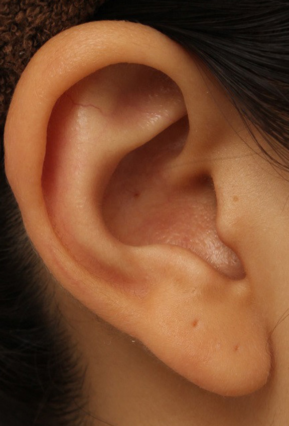 耳介軟骨移植（鼻先を出す）,鼻シリコンプロテーゼ+鼻先の耳介軟骨移植を行い自然な形で鼻筋を通した症例写真,After（6ヶ月後）,ba_ryubi1048_b04.jpg
