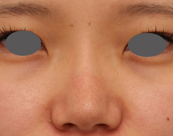 耳介軟骨移植（鼻先を出す）,鼻シリコンプロテーゼ+鼻先の耳介軟骨移植を行い自然な形で鼻筋を通した症例写真,Before,ba_ryubi1048_b01.jpg