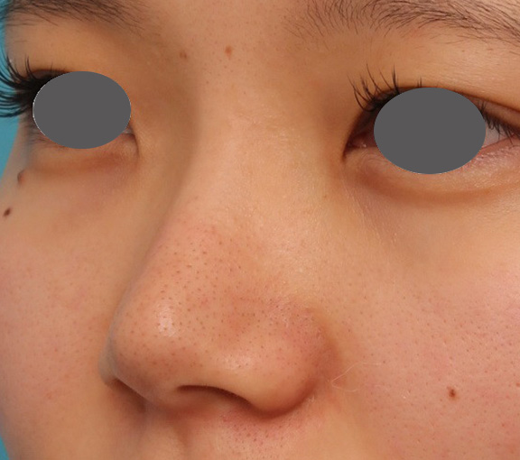 隆鼻術（シリコンプロテーゼ）,鼻シリコンプロテーゼ+鼻先の耳介軟骨移植を行い自然な形で鼻筋を通した症例写真,Before,ba_ryubi1048_b02.jpg