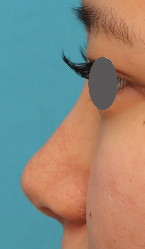 隆鼻術（シリコンプロテーゼ）,鼻シリコンプロテーゼ+鼻先の耳介軟骨移植を行い自然な形で鼻筋を通した症例写真,Before,ba_ryubi1048_b03.jpg