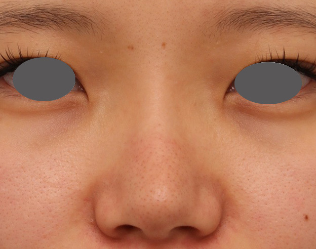 隆鼻術（シリコンプロテーゼ）,鼻シリコンプロテーゼ+鼻先の耳介軟骨移植を行い自然な形で鼻筋を通した症例写真,手術前,mainpic_ryubi1048a.jpg