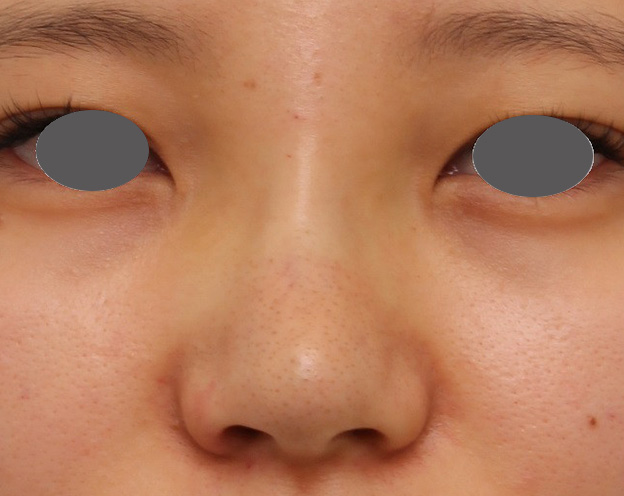 耳介軟骨移植（鼻先を出す）,鼻シリコンプロテーゼ+鼻先の耳介軟骨移植を行い自然な形で鼻筋を通した症例写真,手術直後,mainpic_ryubi1048b.jpg