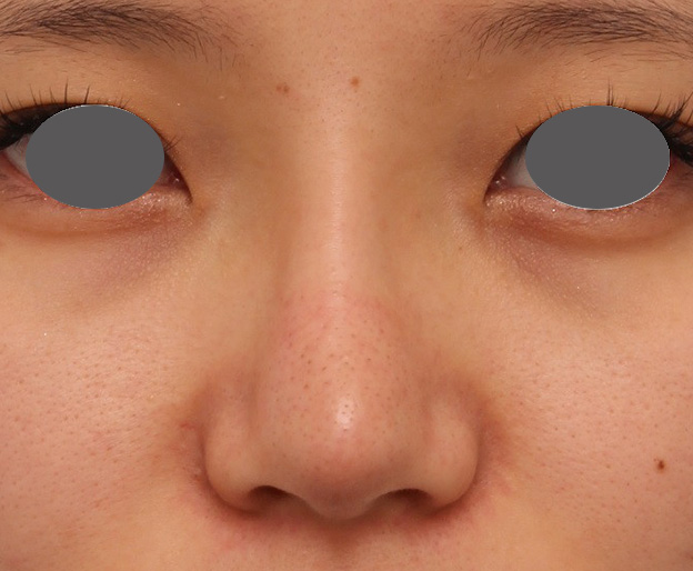 隆鼻術（シリコンプロテーゼ）,鼻シリコンプロテーゼ+鼻先の耳介軟骨移植を行い自然な形で鼻筋を通した症例写真,1ヶ月後,mainpic_ryubi1048c.jpg