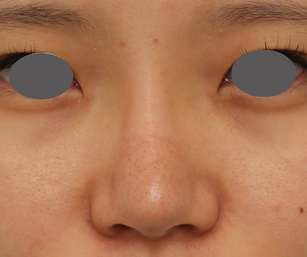 耳介軟骨移植（鼻先を出す）,鼻シリコンプロテーゼ+鼻先の耳介軟骨移植を行い自然な形で鼻筋を通した症例写真,3ヶ月後,mainpic_ryubi1048d.jpg