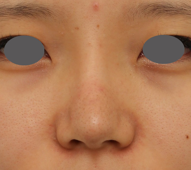 隆鼻術（シリコンプロテーゼ）,鼻シリコンプロテーゼ+鼻先の耳介軟骨移植を行い自然な形で鼻筋を通した症例写真,6ヶ月後,mainpic_ryubi1048e.jpg