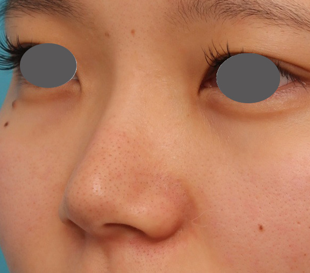 隆鼻術（シリコンプロテーゼ）,鼻シリコンプロテーゼ+鼻先の耳介軟骨移植を行い自然な形で鼻筋を通した症例写真,手術前,mainpic_ryubi1048f.jpg