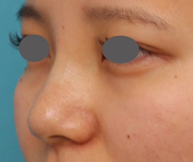 耳介軟骨移植（鼻先を出す）,鼻シリコンプロテーゼ+鼻先の耳介軟骨移植を行い自然な形で鼻筋を通した症例写真,手術直後,mainpic_ryubi1048g.jpg