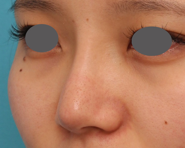 隆鼻術（シリコンプロテーゼ）,鼻シリコンプロテーゼ+鼻先の耳介軟骨移植を行い自然な形で鼻筋を通した症例写真,1ヶ月後,mainpic_ryubi1048h.jpg