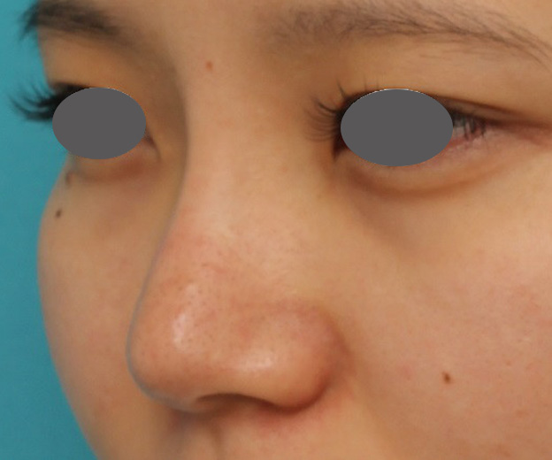 症例写真,鼻シリコンプロテーゼ+鼻先の耳介軟骨移植を行い自然な形で鼻筋を通した症例写真,3ヶ月後,mainpic_ryubi1048i.jpg