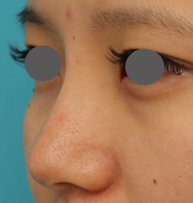 耳介軟骨移植（鼻先を出す）,鼻シリコンプロテーゼ+鼻先の耳介軟骨移植を行い自然な形で鼻筋を通した症例写真,6ヶ月後,mainpic_ryubi1048j.jpg