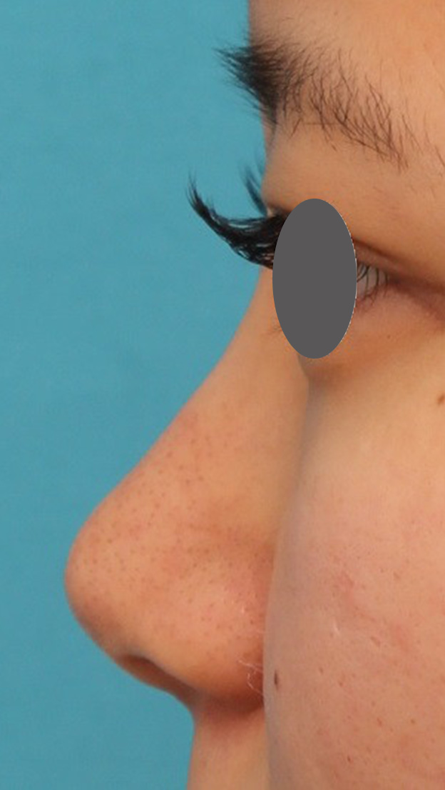 耳介軟骨移植（鼻先を出す）,鼻シリコンプロテーゼ+鼻先の耳介軟骨移植を行い自然な形で鼻筋を通した症例写真,手術前,mainpic_ryubi1048k.jpg