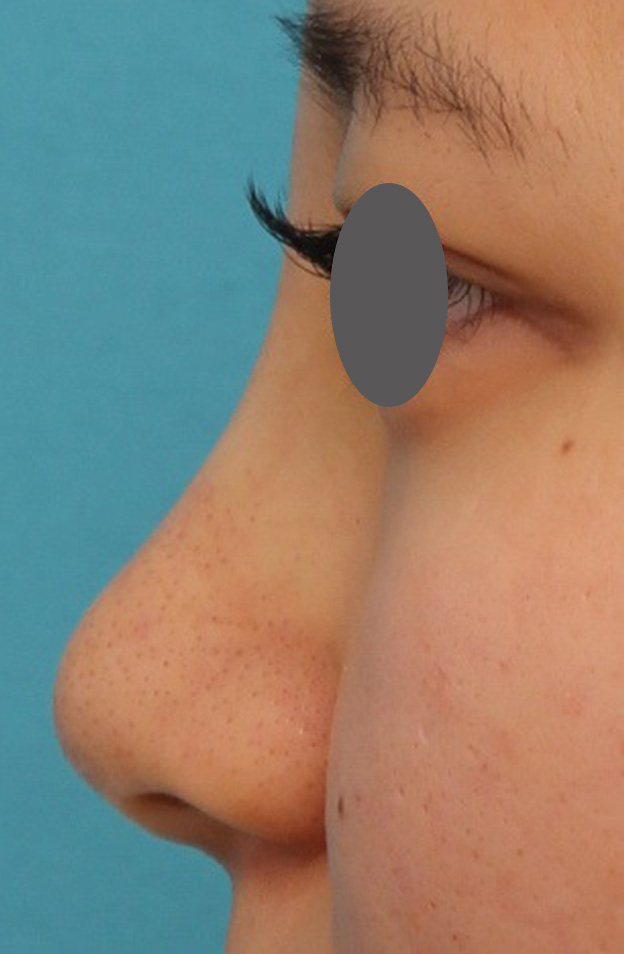 耳介軟骨移植（鼻先を出す）,鼻シリコンプロテーゼ+鼻先の耳介軟骨移植を行い自然な形で鼻筋を通した症例写真,手術直後,mainpic_ryubi1048l.jpg