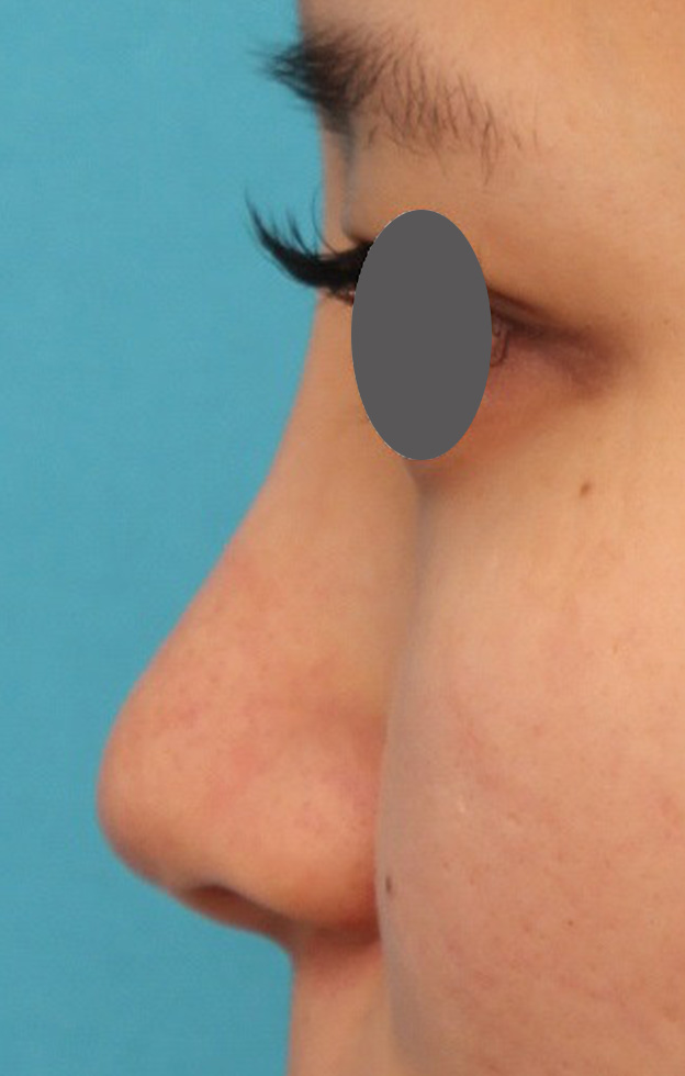 隆鼻術（シリコンプロテーゼ）,鼻シリコンプロテーゼ+鼻先の耳介軟骨移植を行い自然な形で鼻筋を通した症例写真,1ヶ月後,mainpic_ryubi1048m.jpg