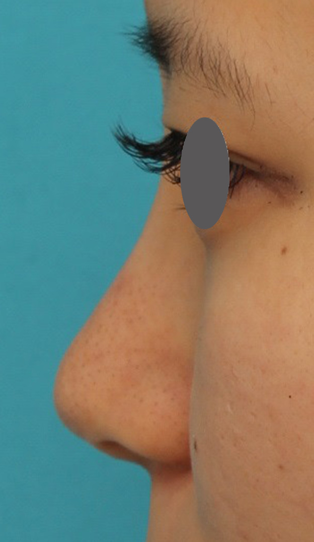 症例写真,鼻シリコンプロテーゼ+鼻先の耳介軟骨移植を行い自然な形で鼻筋を通した症例写真,6ヶ月後,mainpic_ryubi1048o.jpg