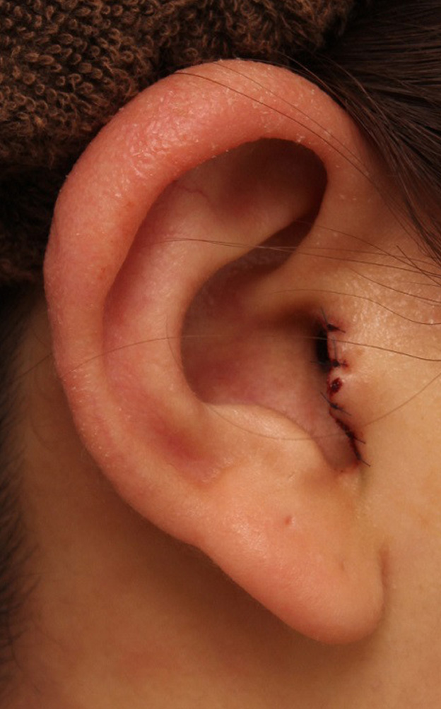 耳介軟骨移植（鼻先を出す）,鼻シリコンプロテーゼ+鼻先の耳介軟骨移植を行い自然な形で鼻筋を通した症例写真,手術直後,mainpic_ryubi1048q.jpg