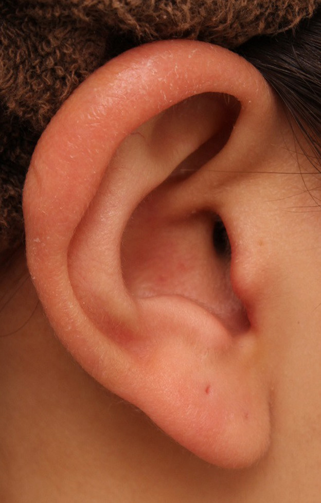 耳介軟骨移植（鼻先を出す）,鼻シリコンプロテーゼ+鼻先の耳介軟骨移植を行い自然な形で鼻筋を通した症例写真,1ヶ月後,mainpic_ryubi1048r.jpg