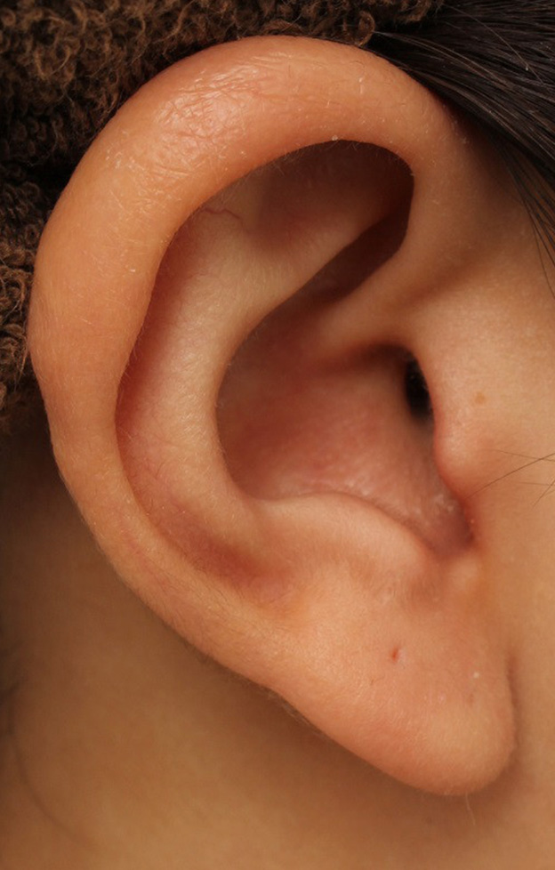 耳介軟骨移植（鼻先を出す）,鼻シリコンプロテーゼ+鼻先の耳介軟骨移植を行い自然な形で鼻筋を通した症例写真,3ヶ月後,mainpic_ryubi1048s.jpg