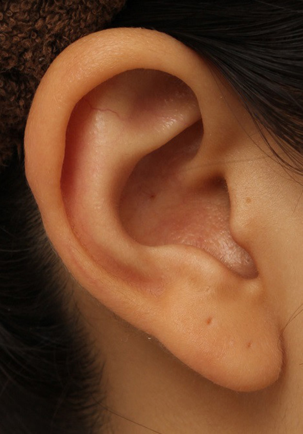 隆鼻術（シリコンプロテーゼ）,鼻シリコンプロテーゼ+鼻先の耳介軟骨移植を行い自然な形で鼻筋を通した症例写真,6ヶ月後,mainpic_ryubi1048t.jpg