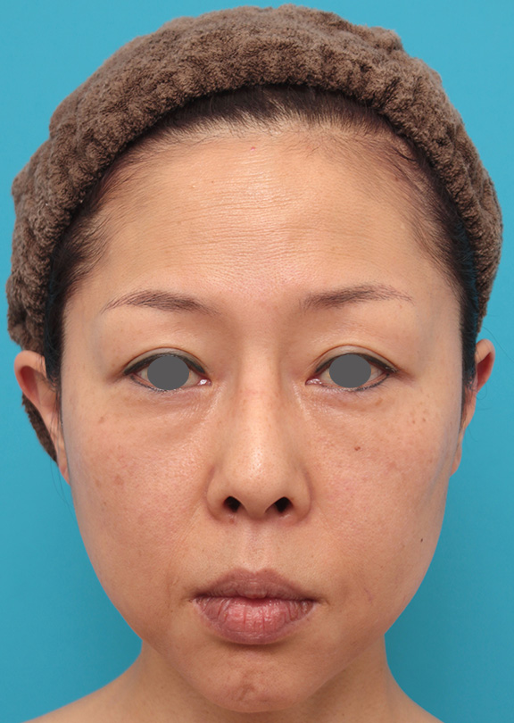 イタリアンリフトファインで顔全体の肌の張りが出て引き締まった40代女性の症例写真,After（6ヶ月後）,ba_italianlift_fine018_a01.jpg