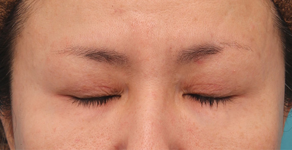 垂れ目（パンダ目）形成（グラマラスライン／下眼瞼下制術）,上まぶたたるみ取り手術とタレ目形成（グラマラスライン）を同時に行った40代女性の症例写真,After（6ヶ月後）,