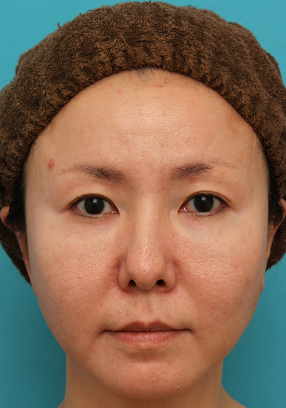 上まぶたたるみ取り,上まぶたたるみ取り手術とタレ目形成（グラマラスライン）を同時に行った40代女性の症例写真,Before,ba_tarumi013_b01.jpg