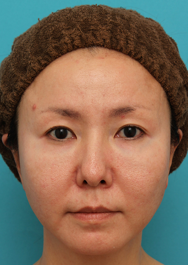 垂れ目（パンダ目）形成（グラマラスライン／下眼瞼下制術）,上まぶたたるみ取り手術とタレ目形成（グラマラスライン）を同時に行った40代女性の症例写真,手術前,mainpic_tarumi013a.jpg