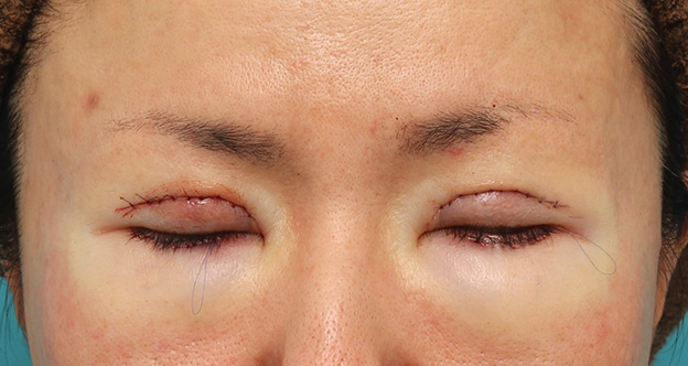 垂れ目（パンダ目）形成（グラマラスライン／下眼瞼下制術）,上まぶたたるみ取り手術とタレ目形成（グラマラスライン）を同時に行った40代女性の症例写真,手術直後,目を閉じた状態,mainpic_tarumi013c.jpg
