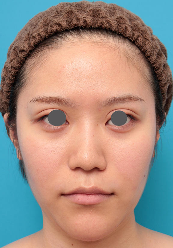 隆鼻術（シリコンプロテーゼ）,鼻のシリコンプロテーゼと鼻先の耳介軟骨移植を同時に行った症例写真,After（6ヶ月後）,ba_ryubi1049_b01.jpg