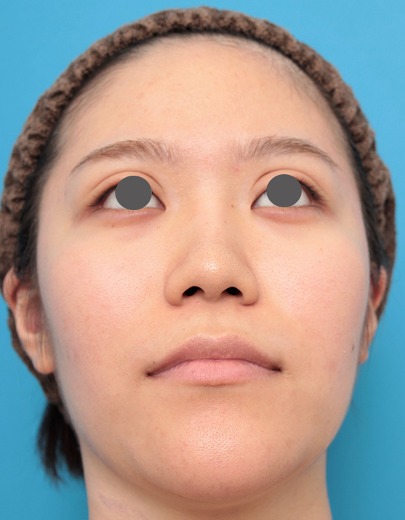 隆鼻術（シリコンプロテーゼ）,鼻のシリコンプロテーゼと鼻先の耳介軟骨移植を同時に行った症例写真,After（6ヶ月後）,ba_ryubi1049_b03.jpg