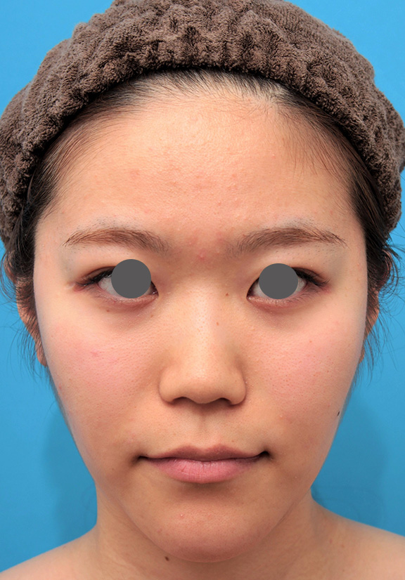 隆鼻術（シリコンプロテーゼ）,鼻のシリコンプロテーゼと鼻先の耳介軟骨移植を同時に行った症例写真,Before,ba_ryubi1049_b01.jpg