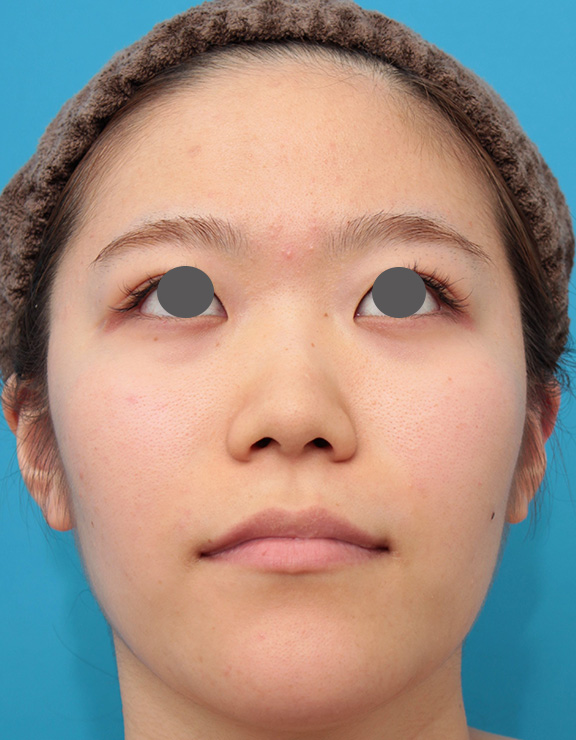 耳介軟骨移植（鼻先を出す）,鼻のシリコンプロテーゼと鼻先の耳介軟骨移植を同時に行った症例写真,Before,ba_ryubi1049_b03.jpg