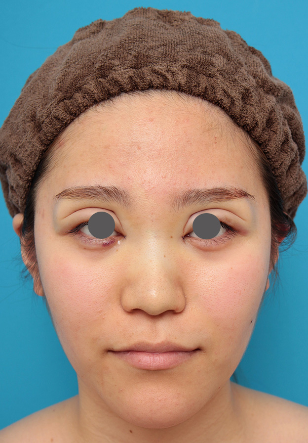 隆鼻術（シリコンプロテーゼ）,鼻のシリコンプロテーゼと鼻先の耳介軟骨移植を同時に行った症例写真,手術直後,mainpic_ryubi1049b.jpg