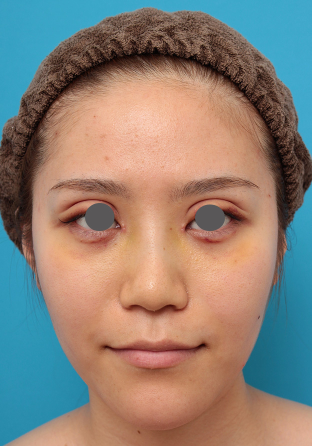 隆鼻術（シリコンプロテーゼ）,鼻のシリコンプロテーゼと鼻先の耳介軟骨移植を同時に行った症例写真,1週間後,mainpic_ryubi1049c.jpg
