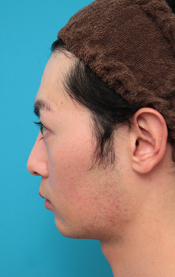 医療レーザー脱毛,男性の濃い髭をレーザー永久脱毛で薄くした症例写真,Before,ba_epi009_b06.jpg